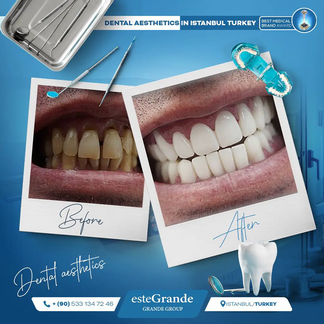 DENTAL-transplant-02
