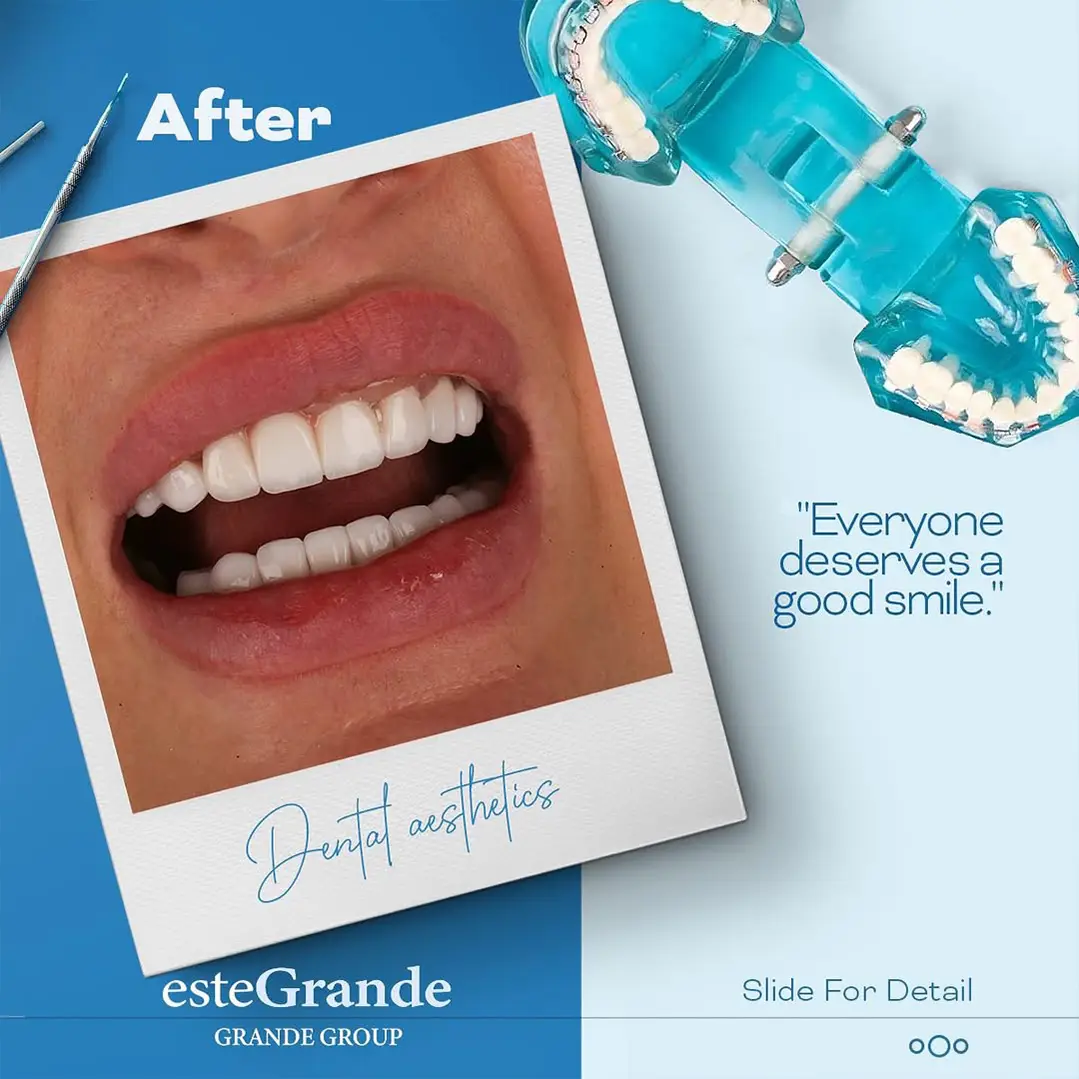 DENTAL-transplant-08