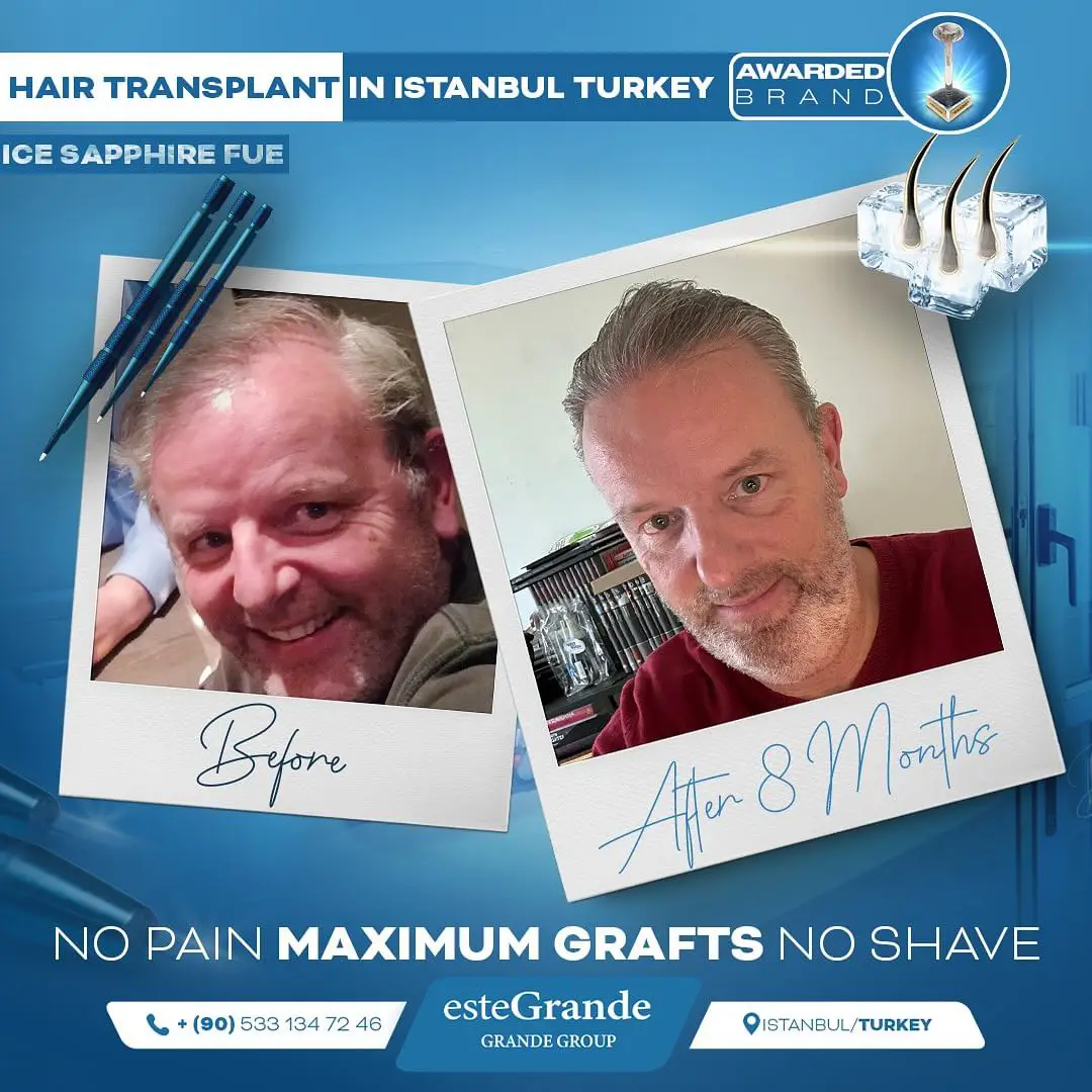 este-grande-hair-transplant-before-after-01