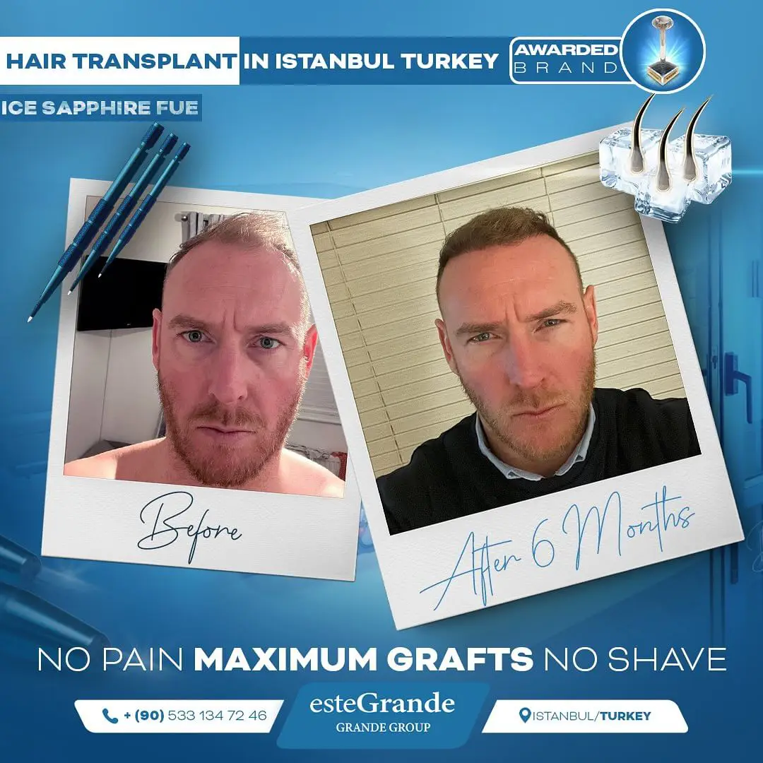 este-grande-hair-transplant-before-after-02