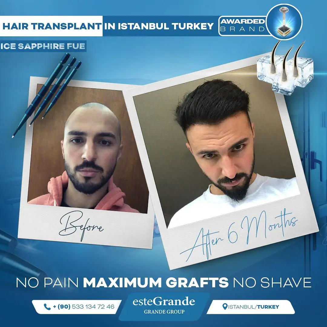 este-grande-hair-transplant-before-after-03