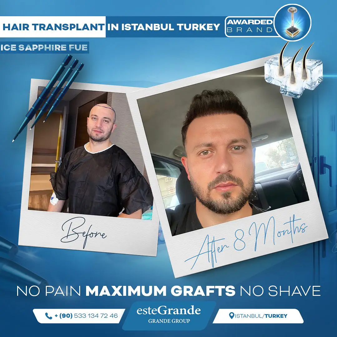 este-grande-hair-transplant-before-after-04