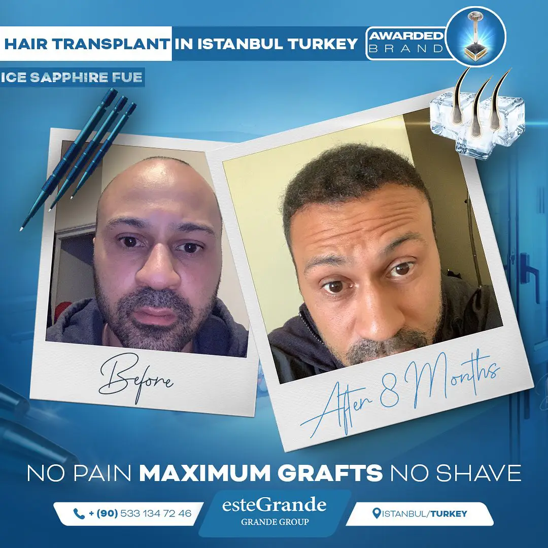 este-grande-hair-transplant-before-after-05