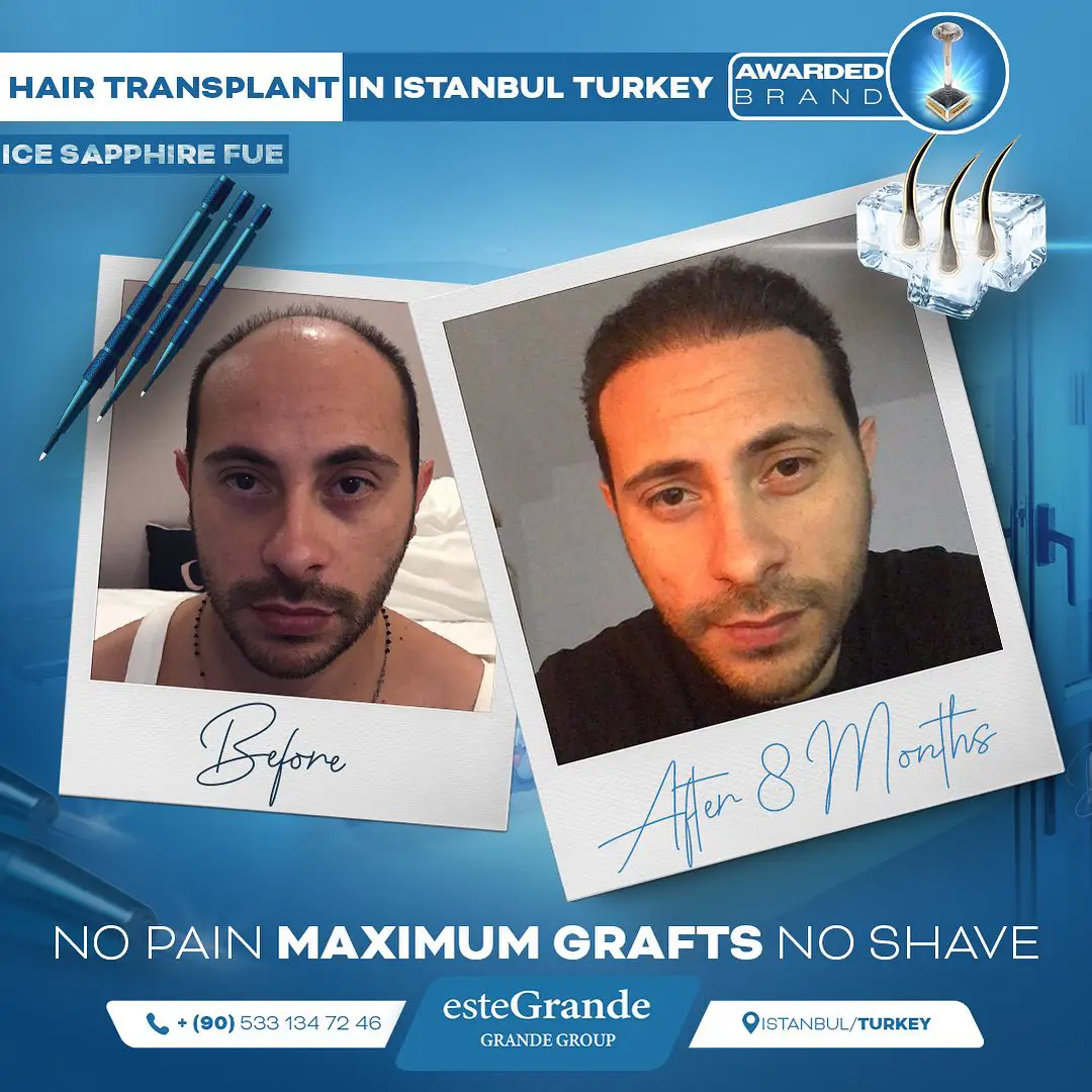 este-grande-hair-transplant-before-after-06