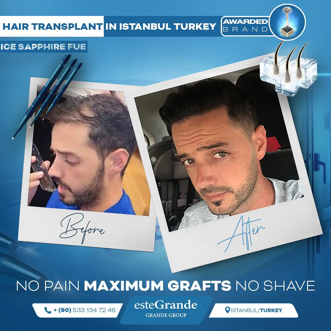 este-grande-hair-transplant-before-after-07