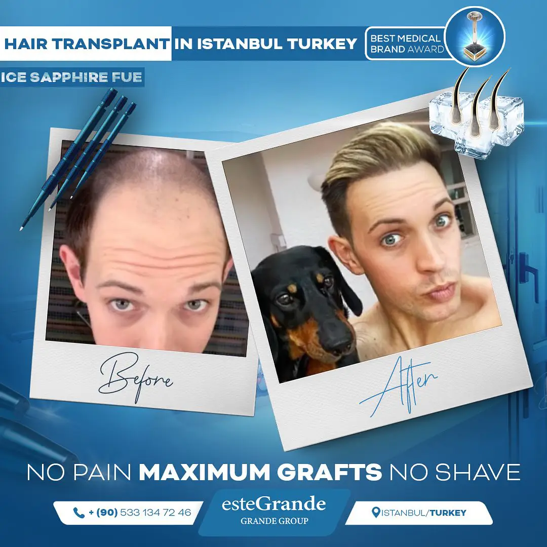 este-grande-hair-transplant-before-after-08