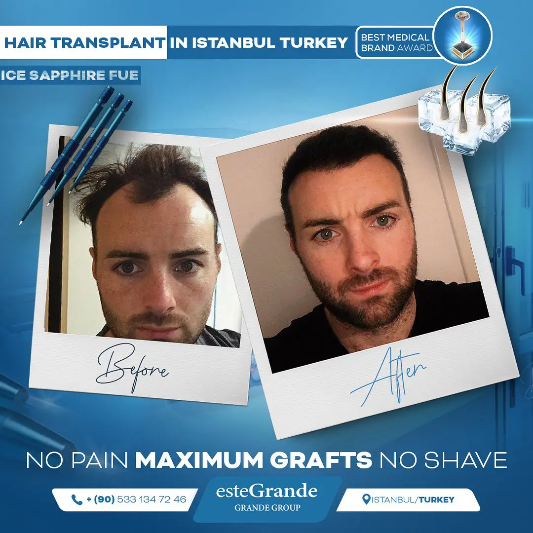 este-grande-hair-transplant-before-after-09