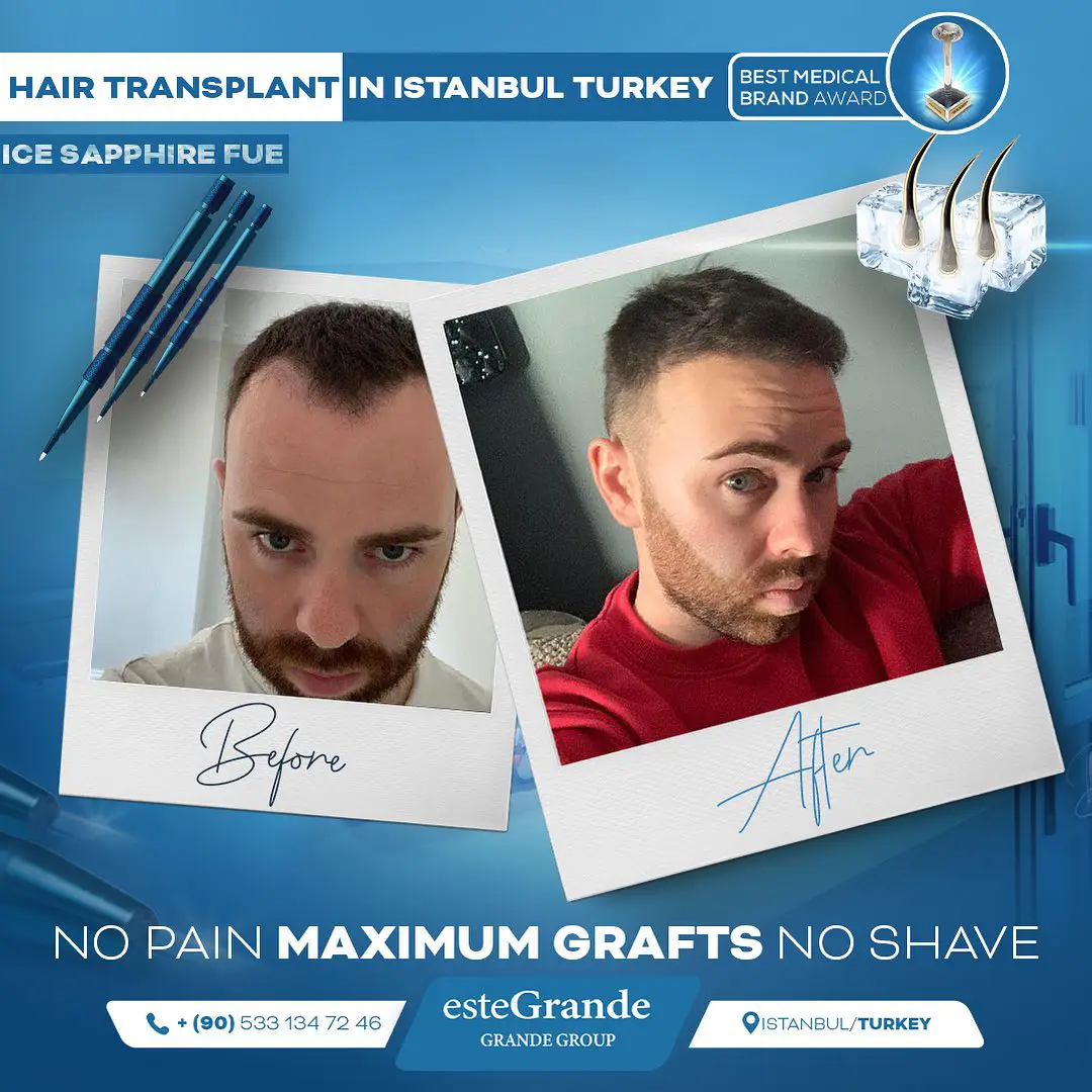 este-grande-hair-transplant-before-after-10