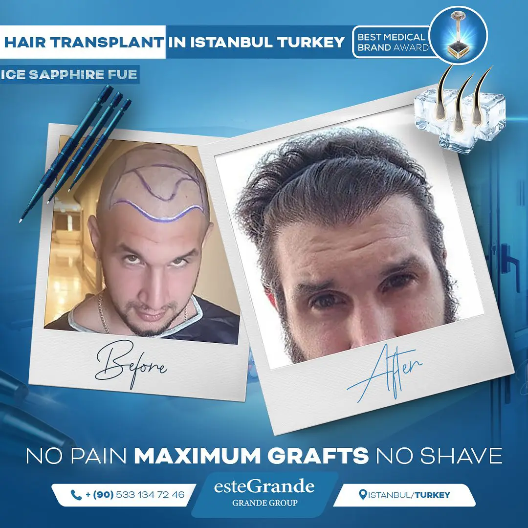 este-grande-hair-transplant-before-after-11