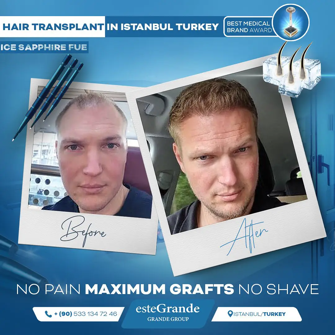 este-grande-hair-transplant-before-after-12