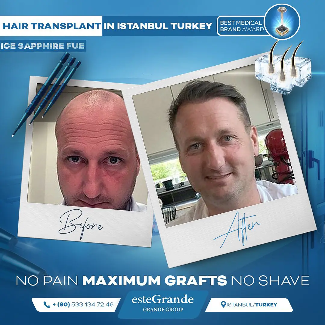 este-grande-hair-transplant-before-after-13