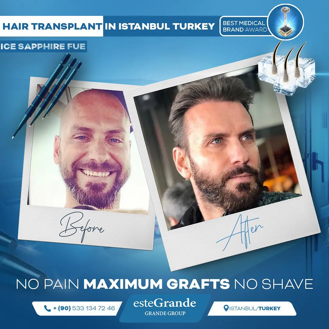 este-grande-hair-transplant-before-after-14