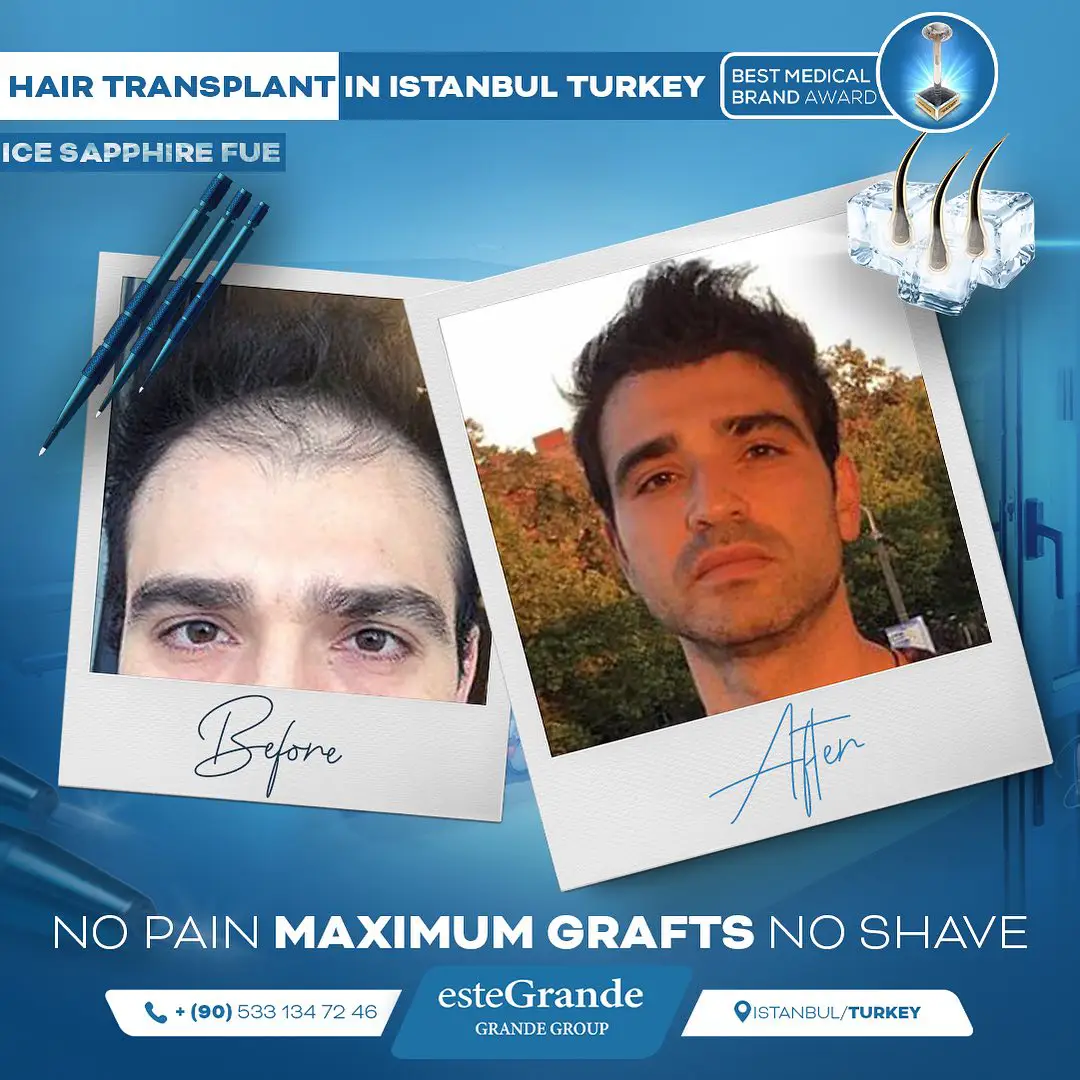 este-grande-hair-transplant-before-after-15