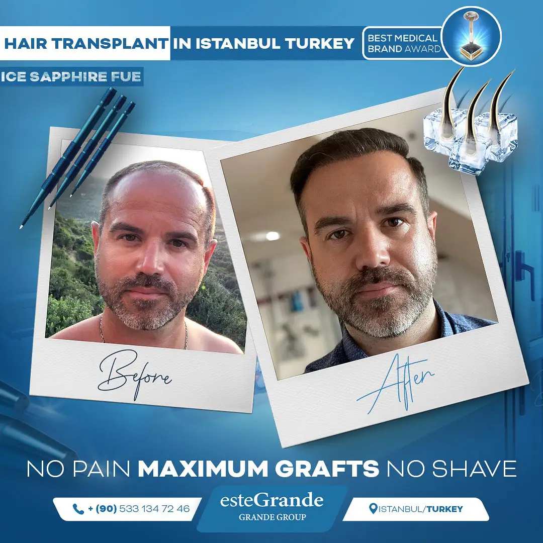 este-grande-hair-transplant-before-after-16