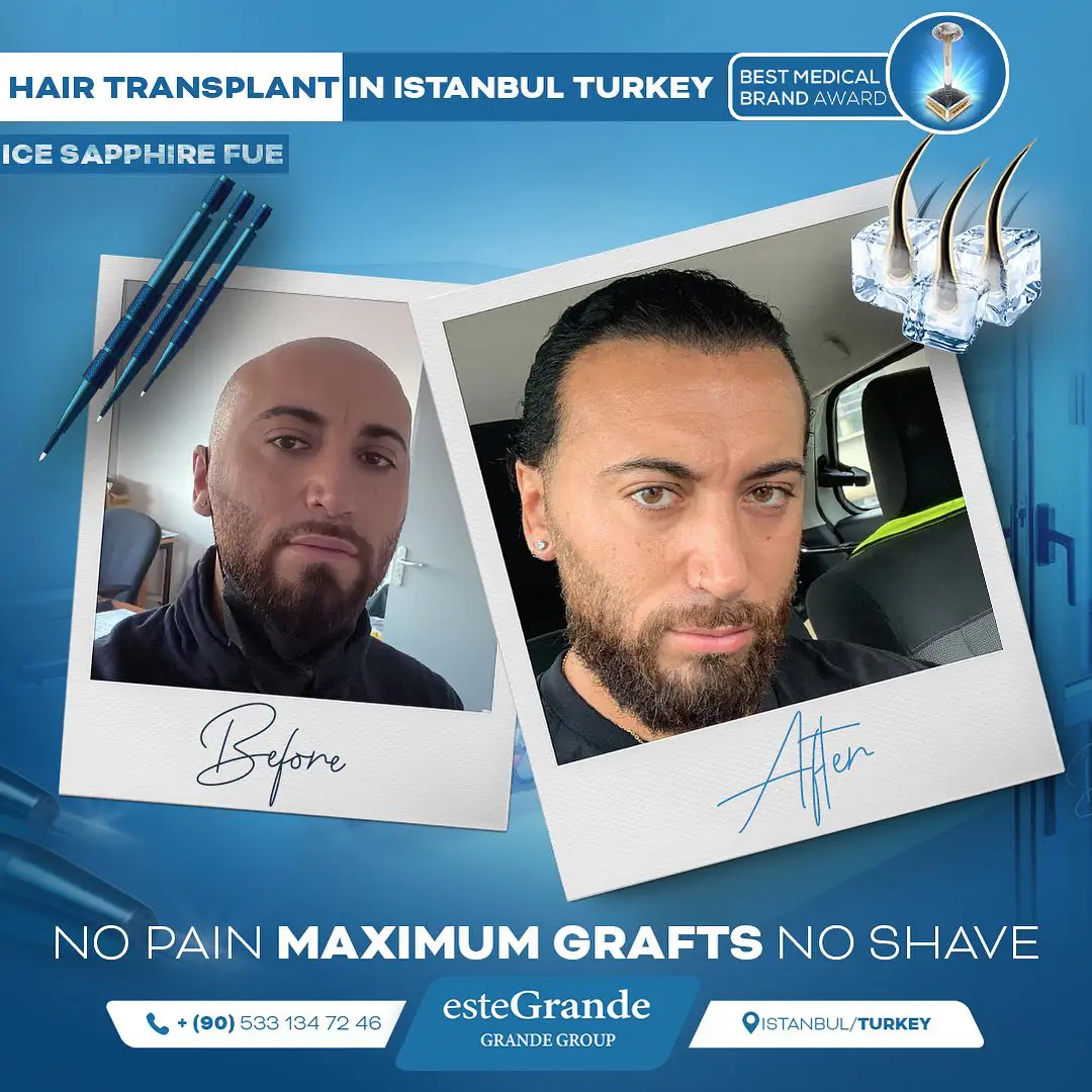 este-grande-hair-transplant-before-after-17