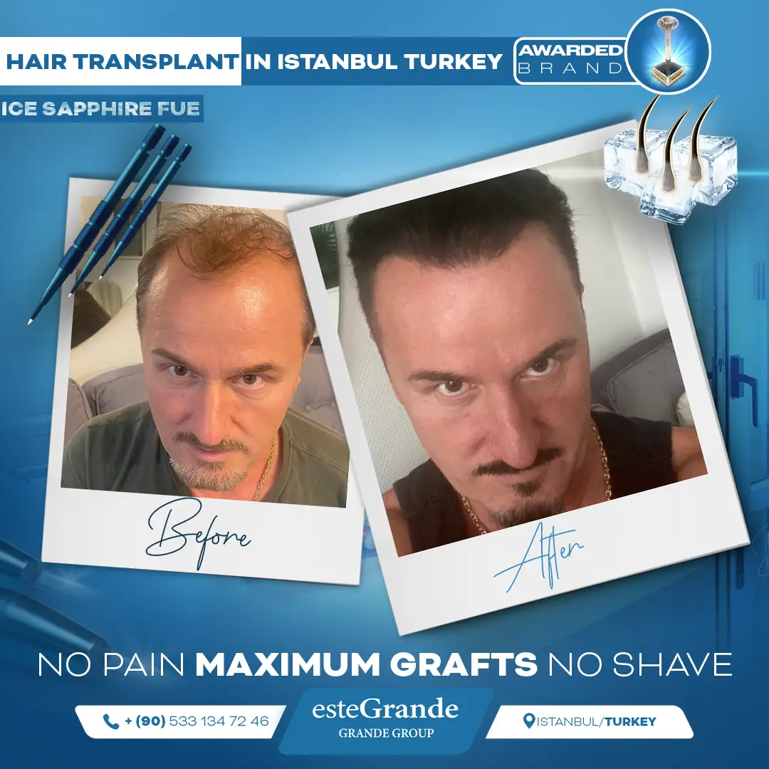 este-grande-hair-transplant-before-after-18