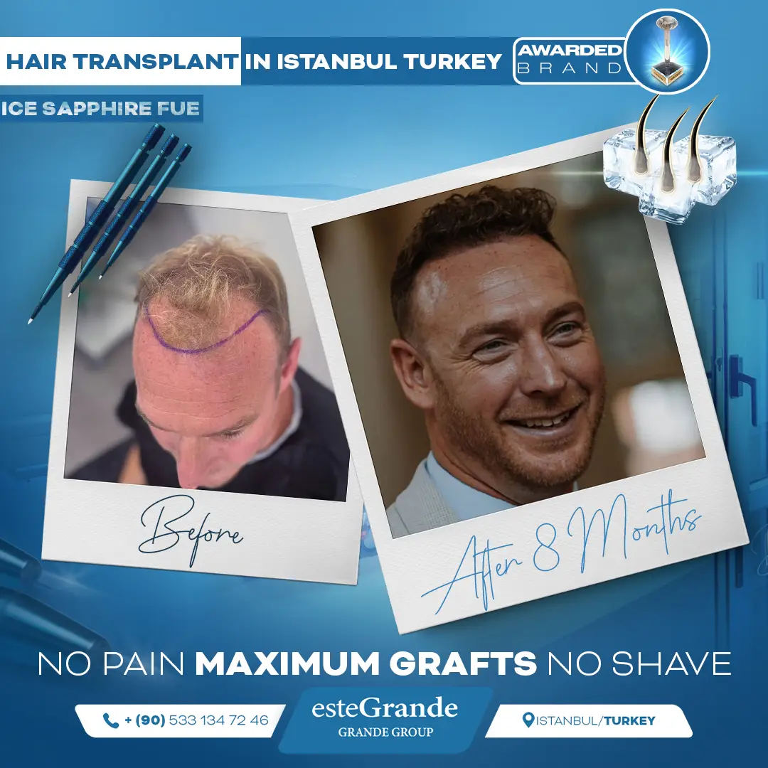 este-grande-hair-transplant-before-after-19
