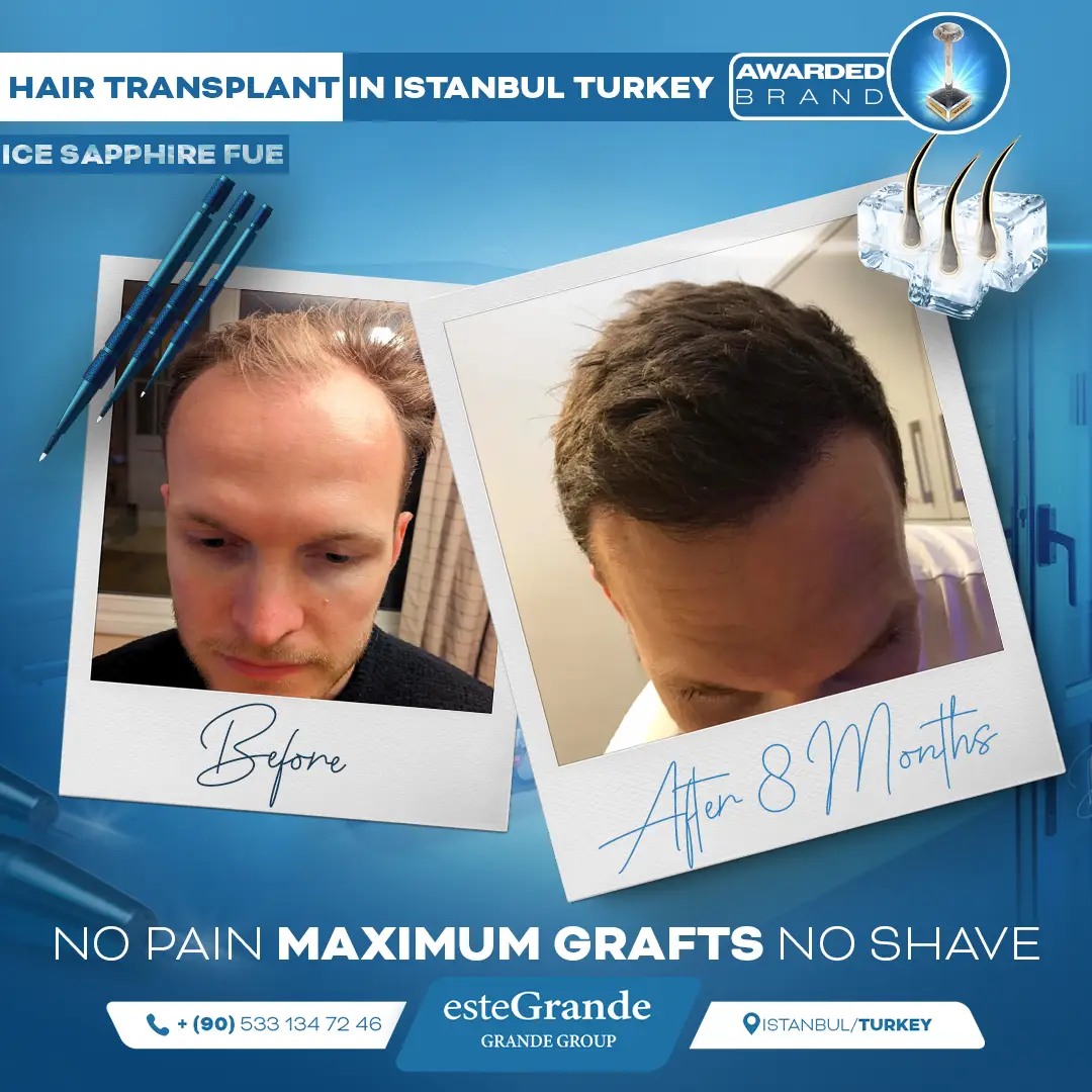 este-grande-hair-transplant-before-after-20