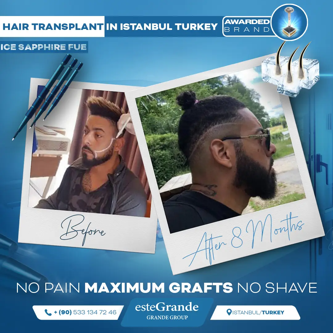 este-grande-hair-transplant-before-after-21