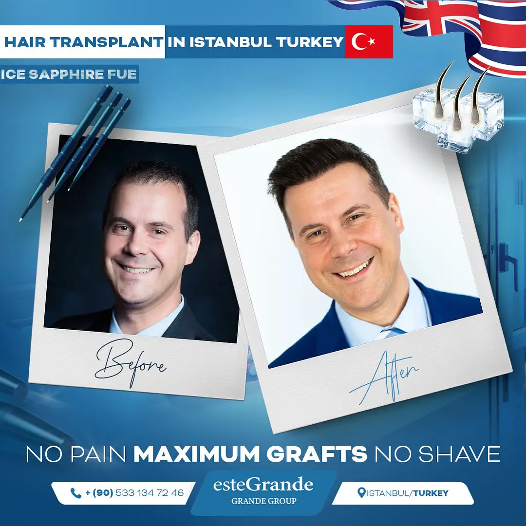 este-grande-hair-transplant-before-after-22