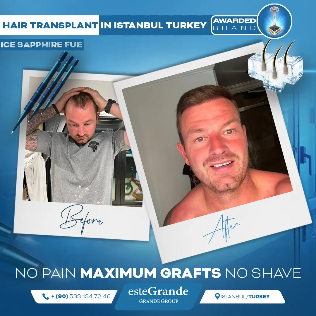 este-grande-hair-transplant-before-after-23