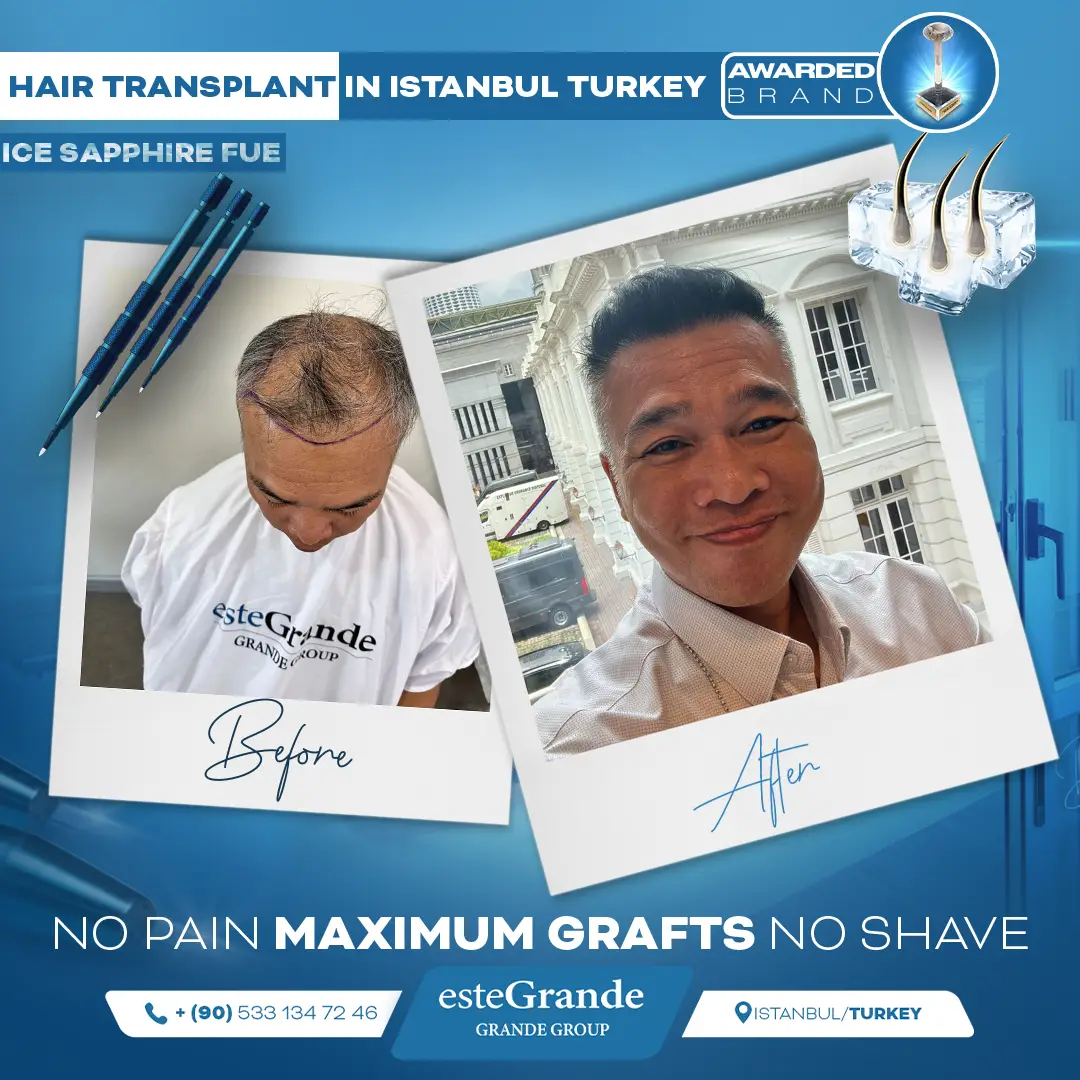 este-grande-hair-transplant-before-after-24