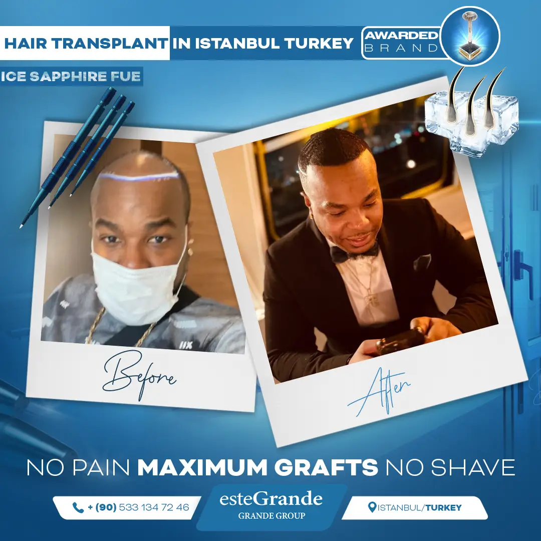 este-grande-hair-transplant-before-after-25